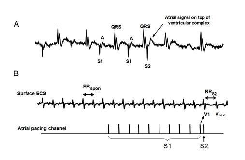 ECG1